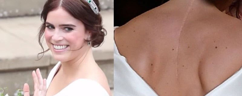 I had the same surgery as Princess Eugenie – and her wedding dress will change the world for many girls